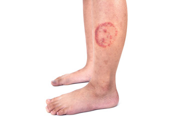 Ringworm infection or Tinea corporis on skin isolated on white background,  Dermatophytosis on skin...