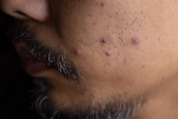 Pimples on the face of asian man
