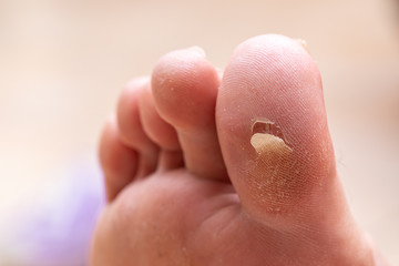 Callus broken in the big toe with dry and dehydrated skin