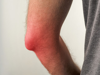 Naklejka premium man with painful elbow or with inflammation