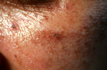 Pigmented spots on the face. Pigmentation on cheeks