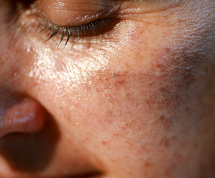 Pigmented spots on the face. Pigmentation on cheeks