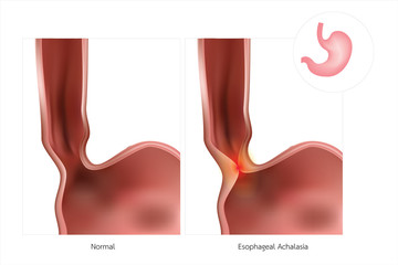 The stomach or esophagus is often referred to as simple Achalasia. The lower esophageal sphincter does not relax, causing inflammation.
