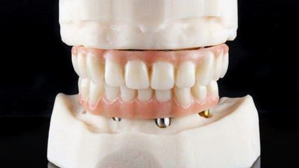 temporary dentures on titanium beams, set in the bite on models