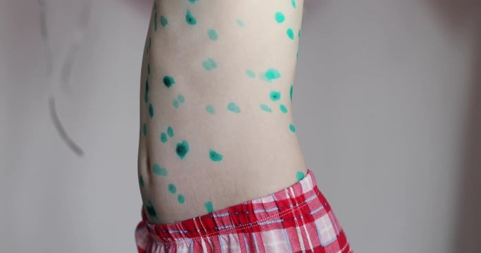 Varicella. A girl is with chickenpox.