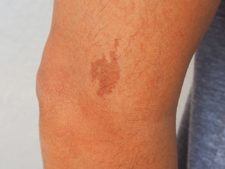 Fototapeta premium dark brow birthmark or cafe au lait ma or CLAMs on the arm near elbow.