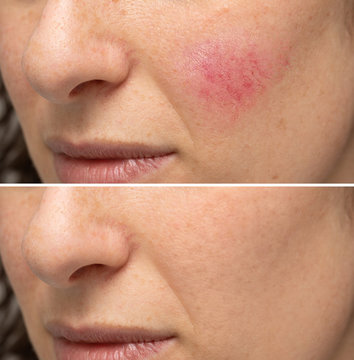 Comparison between before and after a treatment for rosacea