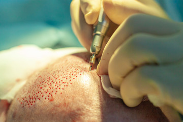 Patient's head close-up. Baldness treatment. Hair transplant. Surgeons in the operating room carry...
