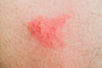 Fototapeta premium Macro shot of bite of sandfly on a man's leg that caused an allergic reaction