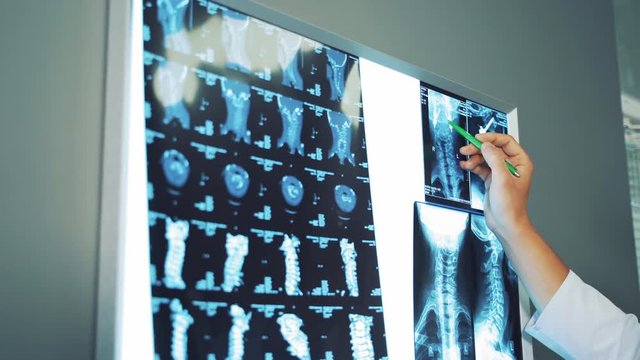Doctor's hand with a pen shows the elements on the x-ray photograph. Spinal x-ray is hanging on a white board and the specialist explains the results indoors.