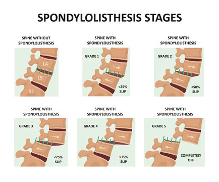 Spondylolisthesis stages