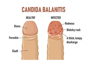 Candida balanitis. Healthy penis and infected