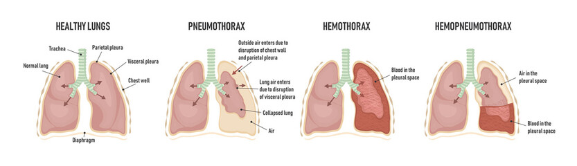 Human lungs with pneumothorax, hemothorax and hemopneumothorax