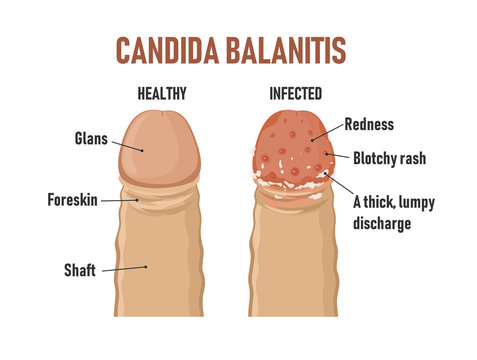 Candida balanitis. Healthy penis and infected