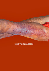Fototapeta premium Close-up of skin with varicose veins