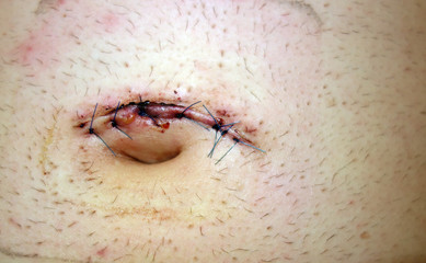 Stitches after umbilical hernia surgery