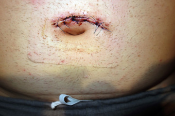 Stitches after umbilical hernia surgery