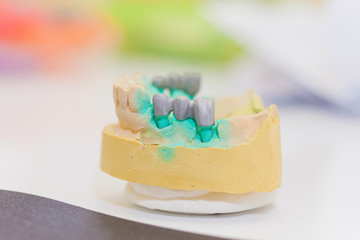 closeup of dental prosthesis mold