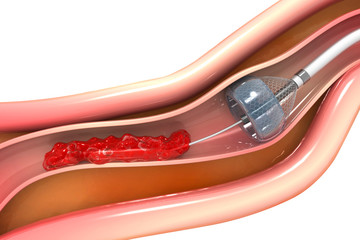 Stent angioplasty.3d illustration..