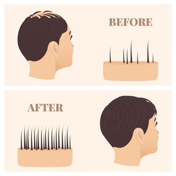 Woman With Thinning Hair Before And After Hair Loss Restoration. Female Pattern Baldness Set With Skin Cross-section Diagram. Treatment Result In Side View. Alopecia Infographics Medical Vector.