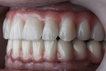 Obraz premium established dental dentures made of polymer and artificial gums, patient's upper and lower jaw