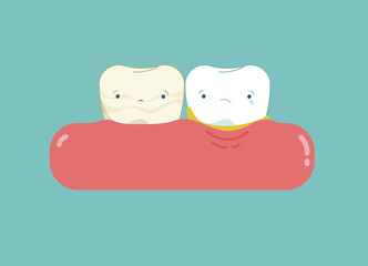 Calculus teeth cartoon, dental concept.