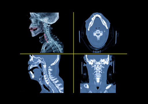 Comparison of CT C-Spine or Cervical spine 3D Rendering image , Axial , Lateral  and  Coronal view with plate and screws