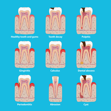 Popular teeth diseases icons in flat design, vector medical illustration. Dental problems infographic elements isolated. Healthy and unhealthy teeth, tooth decay, pulpitis, periodontitis, calculus.