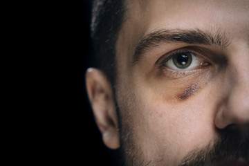 Man with bruise eye hematoma. Wounded victim with black eye.