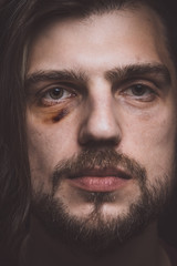 Youn man violence victim with black eye hematoma bruise close-up portrait.