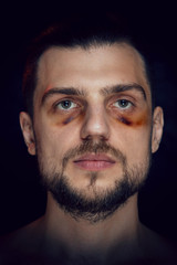 Young man with bruise black eye hematoma, violence victim.