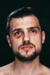 Sad young man with black bruise eye portrait. Violence victim with eye hematoma.