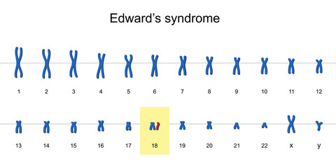 Edward's syndrome karyotype vector ESP10