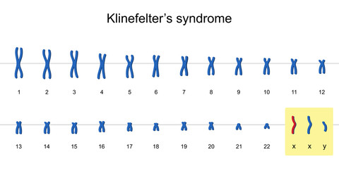 Klinefelter's syndrome karyotype
