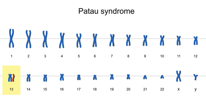 Patau syndrome karyotype