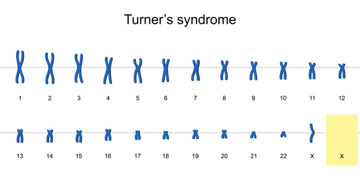 monosomy turner syndrome