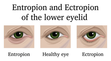 Entropion and Ectropion of the lower eyelid