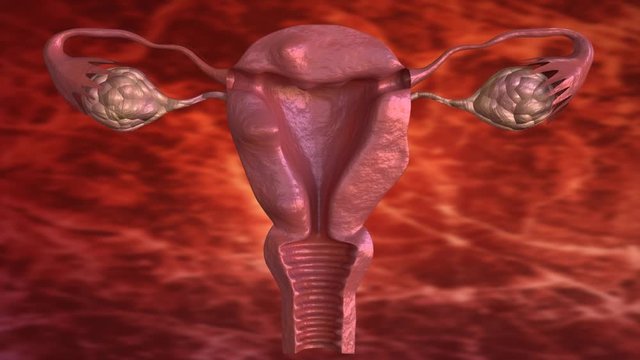 uterine fibroid are benign solid tumors formed by muscle tissue. Its size can vary greatly and some cause large abdomen increase