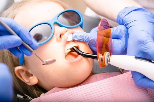 Little Girl Receiving Dental Filling Procedure In Pediatric Dental Clinic