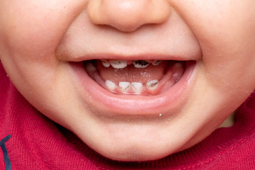 A closeup view on the mouth of a smiling toddler, open lips reveal black spotted milk teeth. A...