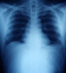 Xray of a human thorax (chest).