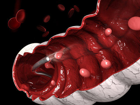 3d illustration of Removal of a colonic polyp with a electrical wire loop during a colonoscopy.