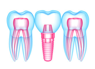 3d render of teeth with dental implant over white