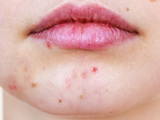 Female face with acne skin problem