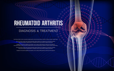 Rheumatoid arthritis Bones the of knee - obrazy, fototapety, plakaty