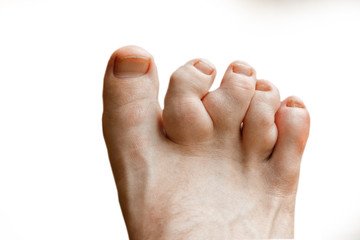 Rheumatoid polyarthritis on the toes, white background. valgus deformity of the toes with pathologic fractures