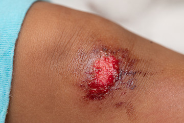 A close-up view of a fresh flesh wound on the knee of an infant. Details of a bleeding and painful...