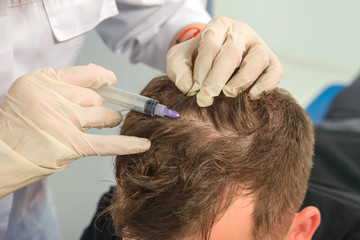 Mesotherapy of the scalp. Male pattern baldness. Bald on the man's head. The doctor makes a shot in...