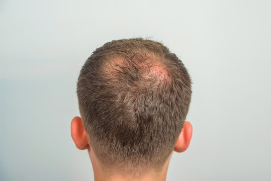The guy in the medical office. Male pattern baldness. Mesotherapy of the scalp. Bald on the man's head. Stock Photo | Adobe Stock The guy in the medical office. Male pattern baldness. Mesotherapy of the scalp. Bald on the man's head. Stock Photo | Adobe Stock