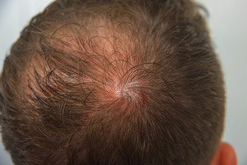 The guy in the medical office. Male pattern baldness. Mesotherapy of the scalp. Bald on the man's...